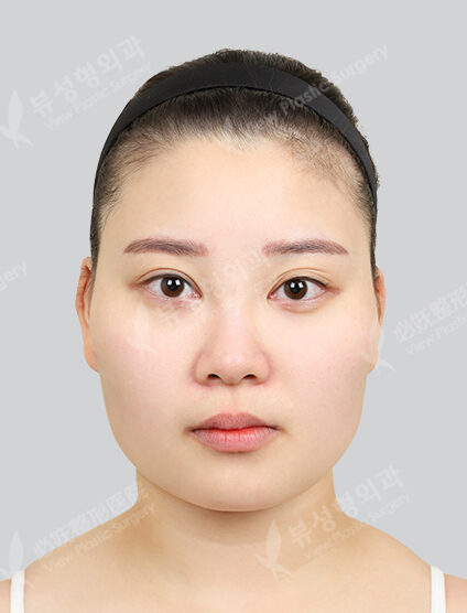Zygoma Reduction+Angular Jaw Reduction+Genioplasty+Acculaser (ChinLine)(6 Months) — Before