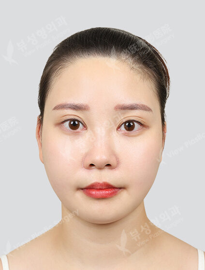 Zygoma Reduction+Angular Jaw Reduction+Genioplasty+Acculaser (ChinLine)(6 Months) — After