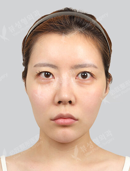 Zygoma Reduction+Angular Jaw Reduction+Genioplasty (6 Months) — Before