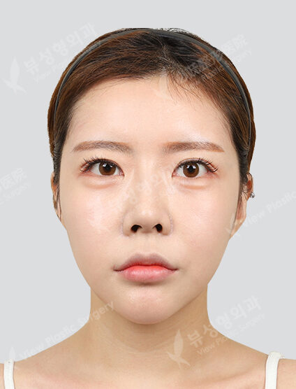 Zygoma Reduction+Angular Jaw Reduction+Genioplasty (6 Months) — After