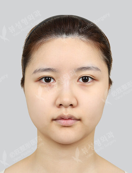 +Accusculpt(4 Months) — Before