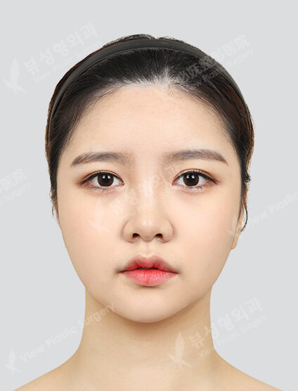 +Accusculpt(4 Months) — After