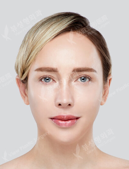 Zygoma Reduction+Angular Jaw Reduction+Genioplasty+PA (6 Months) — After