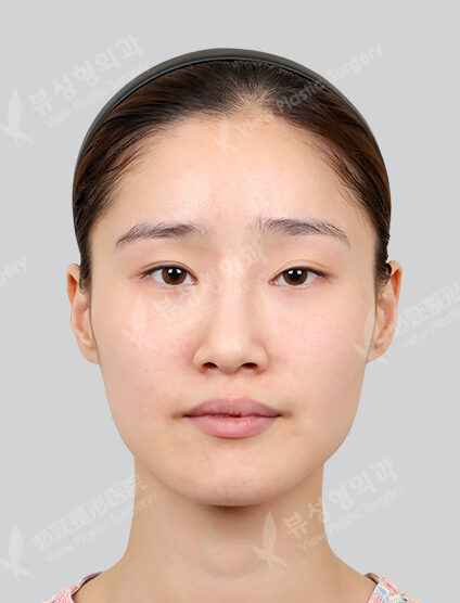Zygoma Reduction+Angular Jaw Reduction+Genioplasty+PA (6 Months) — Before