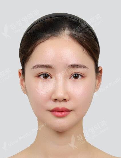 Zygoma Reduction+Angular Jaw Reduction+Genioplasty+PA (6 Months) — After