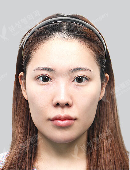 3 Types Face Contouring (Cheekbone+Angular Jaw+Chin Tip)+ Fat Graft (12 Months) — Before