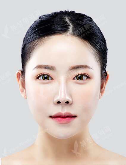 3 Types Face Contouring (Cheekbone+Angular Jaw+Chin Tip)+ Fat Graft (12 Months) — After