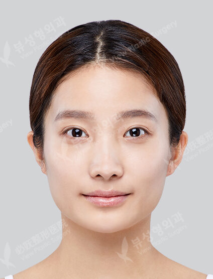 Angular Jaw Reduction+Zygoma Reduction+Fat Graft (6 Months) — Before