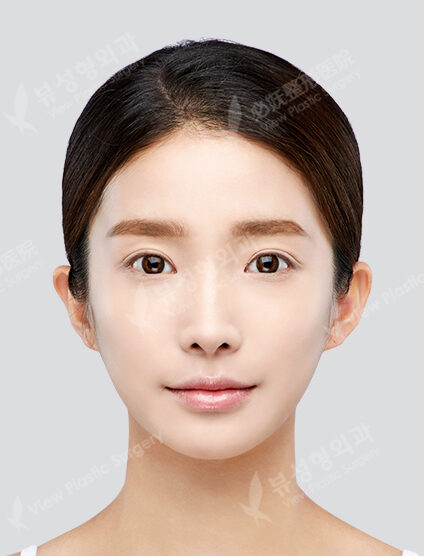 Angular Jaw Reduction+Zygoma Reduction+Fat Graft (6 Months) — After