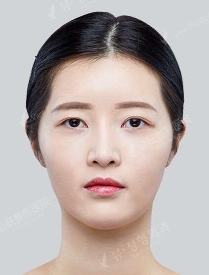 Combination Ptosis Correction Surgery+Lateral CanthoplastyLower Canthoplasty+3 Types Face Contouring (9 Months) — Before