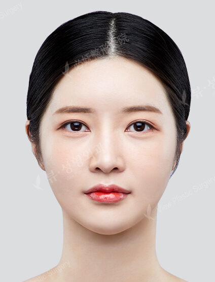 Combination Ptosis Correction Surgery+Lateral CanthoplastyLower Canthoplasty+3 Types Face Contouring (9 Months) — After