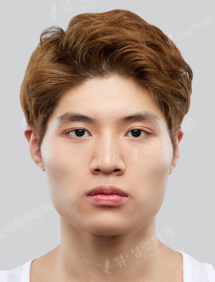 3 Types Face Contouring (Cheekbone+Angular Jaw+Chin Tip)+ Double Eyelid (Incisional)+ Fat Graft (Forehead , Frontal Cheeks)(9 Months) — Before