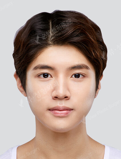 3 Types Face Contouring (Cheekbone+Angular Jaw+Chin Tip)+ Double Eyelid (Incisional)+ Fat Graft (Forehead , Frontal Cheeks)(9 Months) — After