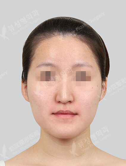 Two Jaw+3 Types Face Contouring (6 Months) — Before