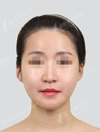 Two Jaw+3 Types Face Contouring (6 Months) — After
