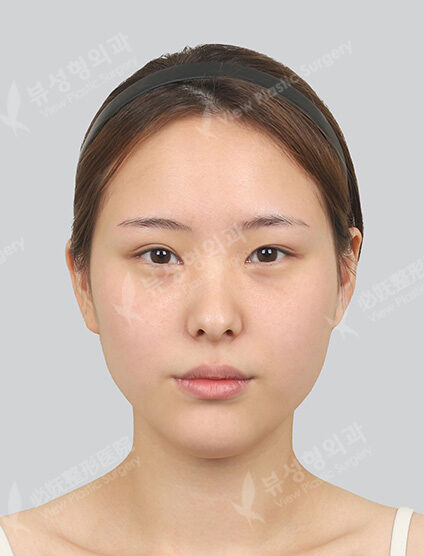 + Fat Graft (ForeheadFrontal CheeksNasolabial)+ Acculift (Double Chin , ChinLine)3 Types Face Contouring+Acculift (Cheeks)+ Filler_6 Months — Before