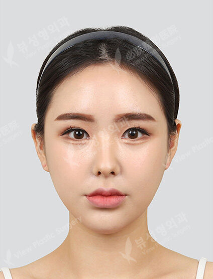 + Fat Graft (ForeheadFrontal CheeksNasolabial)+ Acculift (Double Chin , ChinLine)3 Types Face Contouring+Acculift (Cheeks)+ Filler_6 Months — After