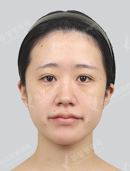 Two Jaw+Angular Jaw+Front Chin (3 Months) — Before