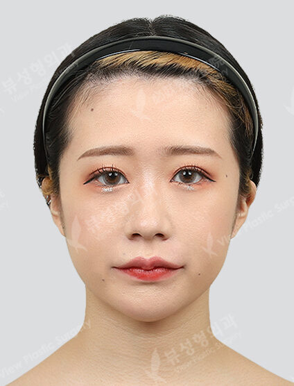 Two Jaw+Angular Jaw+Front Chin (3 Months) — After