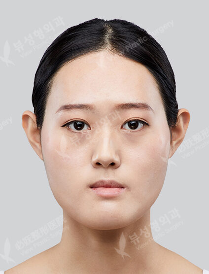Two Jaw+3 Types Face Contouring +(3 Months) — Before