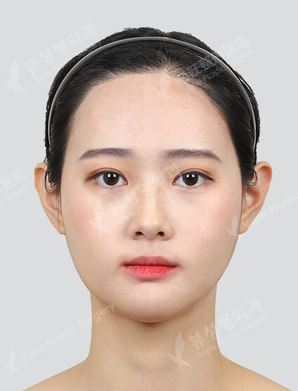 Two Jaw+3 Types Face Contouring +(3 Months) — After