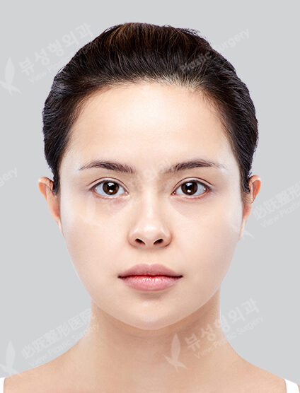 Endotine+Brow Lift+Face Fat Graft+Filler (3 Months) — Before