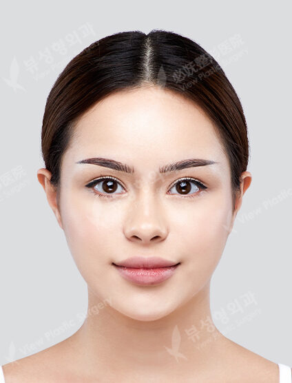 Endotine+Brow Lift+Face Fat Graft+Filler (3 Months) — After