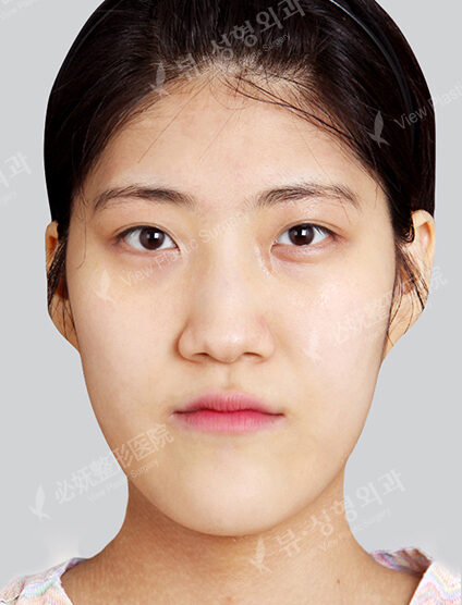Nano Two Jaw+Doll Line (Vline)+ Zygoma Reduction+Forehead Implant+Rhinoplasty+Fat Graft (3 Months) — Before