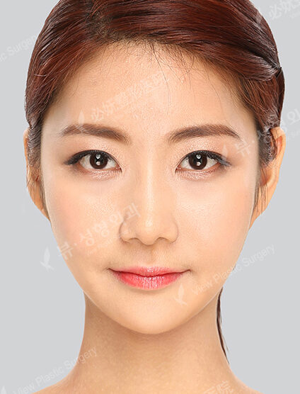 Nano Two Jaw+Doll Line (Vline)+ Zygoma Reduction+Forehead Implant+Rhinoplasty+Fat Graft (3 Months) — After