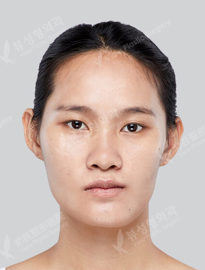 Two Jaw+Cheekbone+Angular Jaw+Chin Tip+Incisional Ptosis Correction+Lateral Canthoplasty+Lower Canthoplasty (6 Months) — Before