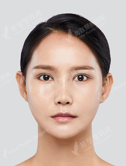 Two Jaw+Cheekbone+Angular Jaw+Chin Tip+Incisional Ptosis Correction+Lateral Canthoplasty+Lower Canthoplasty (6 Months) — After