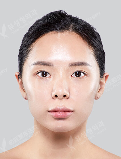Angular Jaw Reduction+Zygoma Reduction+Genioplasty (6 Months) — Before