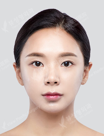 Angular Jaw Reduction+Zygoma Reduction+Genioplasty (6 Months) — After