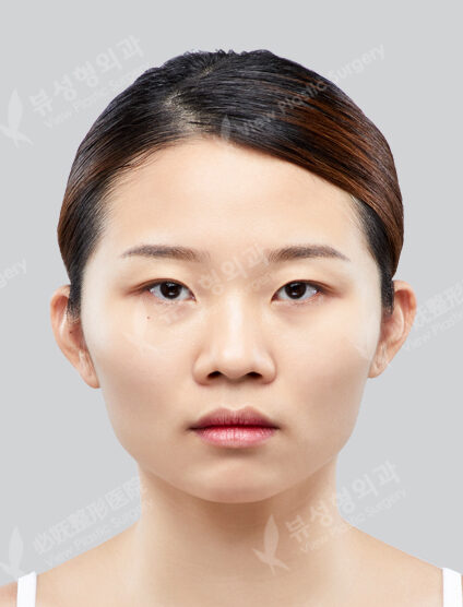 Angular Jaw Reduction+ Zygoma Reduction+Front Chint Osteotomy (6 Months) — Before