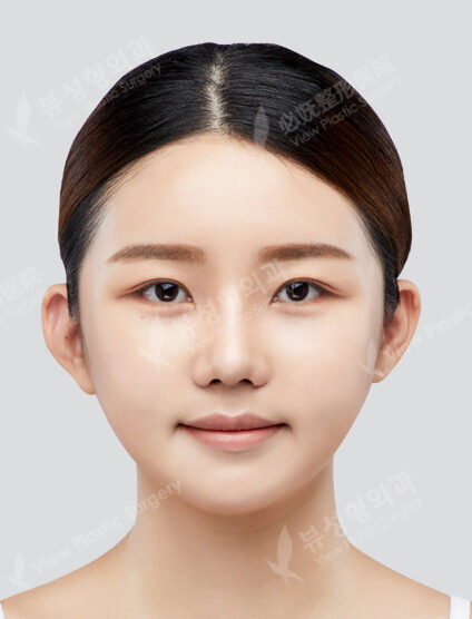 Angular Jaw Reduction+ Zygoma Reduction+Front Chint Osteotomy (6 Months) — After