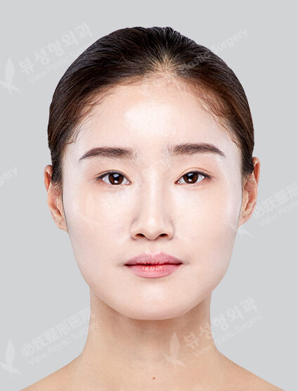 3 Types Face Contouring ++ Incisional Double Eyelid Surgery (Ptosis Correction+Lateral Canthoplasty+Lower Canthoplasty)(6 Months) — Before