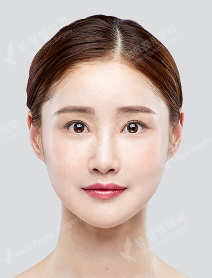 3 Types Face Contouring ++ Incisional Double Eyelid Surgery (Ptosis Correction+Lateral Canthoplasty+Lower Canthoplasty)(6 Months) — After
