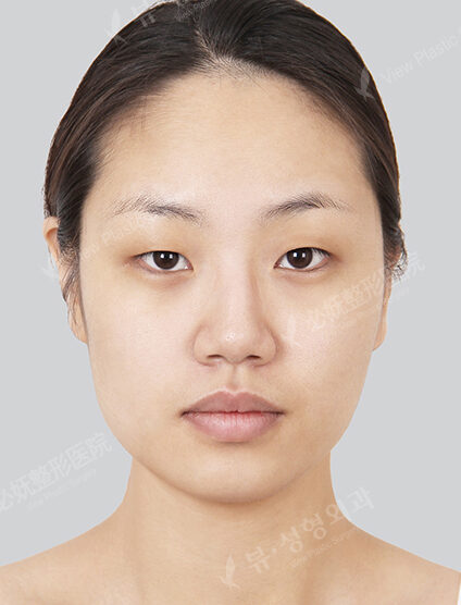 Natural Vline+Zygoma Reduction+Rhinoplasty+Foreign Body Removal+Fat Graft+Eye Surgery (17 Months) — Before