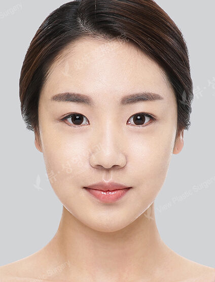 Natural Vline+Zygoma Reduction+Rhinoplasty+Foreign Body Removal+Fat Graft+Eye Surgery (17 Months) — After