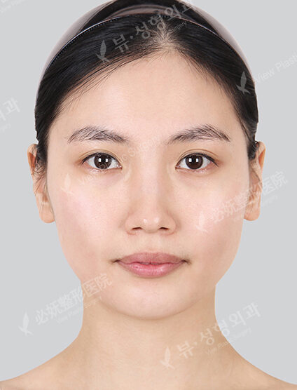 Natural Vline+Zygoma Reduction (4 Months) — Before