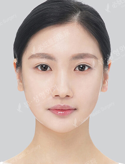 Natural Vline+Zygoma Reduction (4 Months) — After