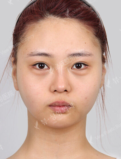 Doll Line (Vline)+ Zygoma Reduction (12 Months) — Before