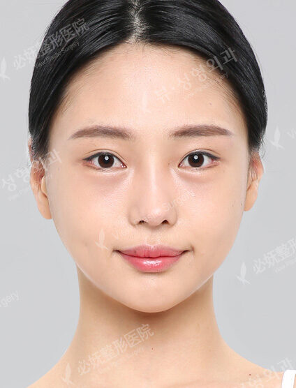 Doll Line (Vline)+ Zygoma Reduction (12 Months) — After