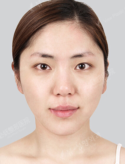Natural Vline+Zygoma Reduction+PA+Rhinoplasty+Eye Surgery+Fat Graft (5 Months) — Before