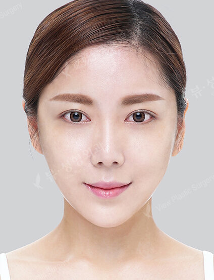 Natural Vline+Zygoma Reduction+PA+Rhinoplasty+Eye Surgery+Fat Graft (5 Months) — After