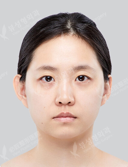 Zygoma Reduction+Genioplasty+Fat Graft (6 Months) — Before