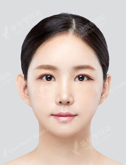 Zygoma Reduction+Genioplasty+Fat Graft (6 Months) — After