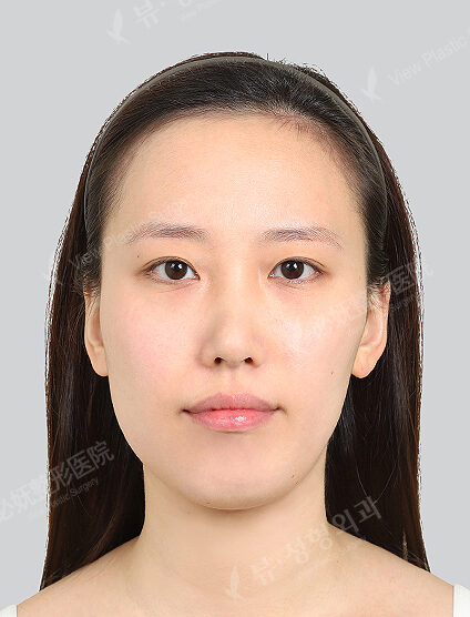 Zygoma Reduction+Angular Jaw Reduction+Genioplasty (6 Months) — Before