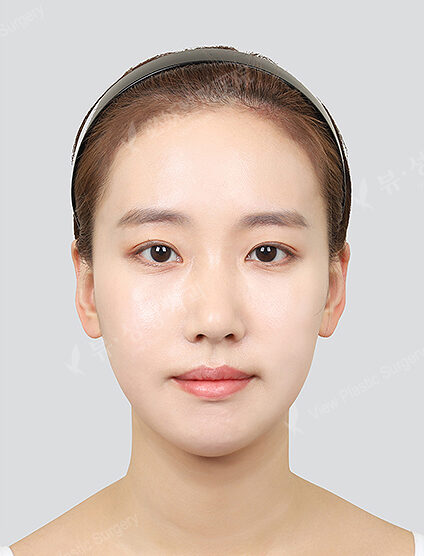 Zygoma Reduction+Angular Jaw Reduction+Genioplasty (6 Months) — After