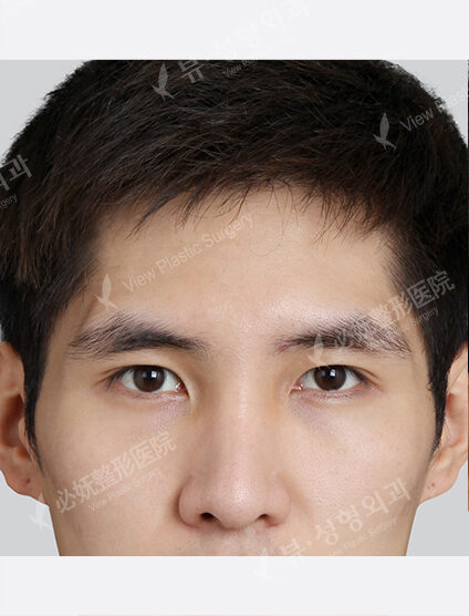 Forehead Fat Graft(2 Months) — Before